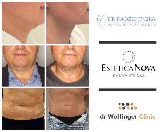 Lifting nieinwazyjny Endolift – co na jego temat mówią lekarze? LIFESTYLE, Uroda - Jak uzyskać́ efekt liftingu i wyszczuplenia bez konieczności użycia skalpela, przygotowywania pacjenta do zabiegu, czasu rekonwalescencji i bez potrzeby wykonywania serii zabiegów?